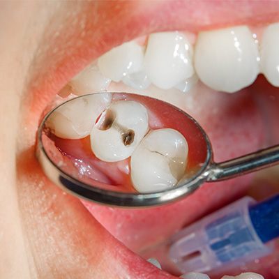 Maladies bucco-dentaires : l'OMS/Europe appelle à agir d'urgence